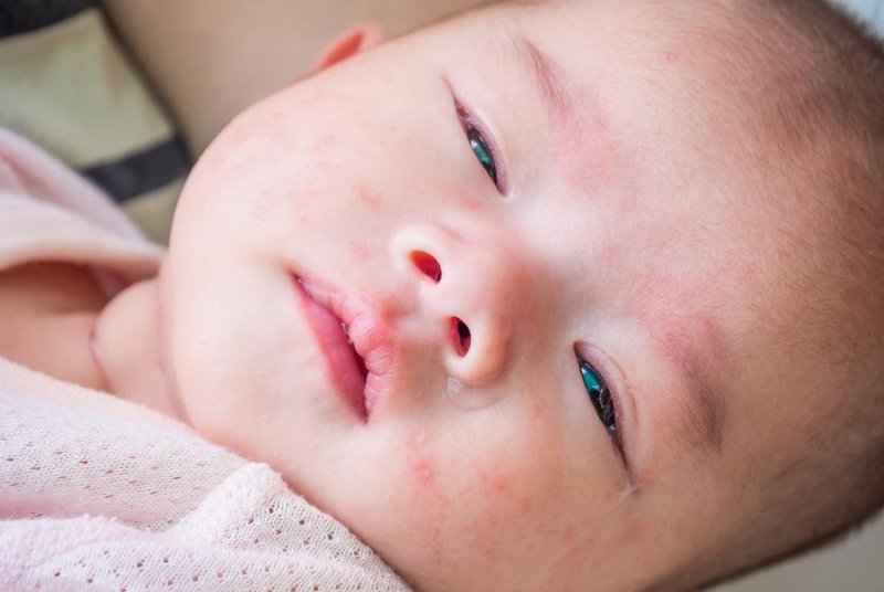 cara menghilangkan biang keringat pada bayi