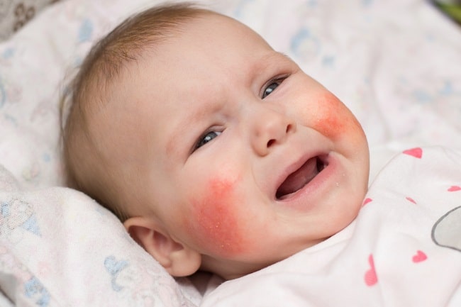 bahaya alergi pada bayi